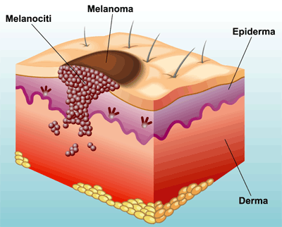 melanoma